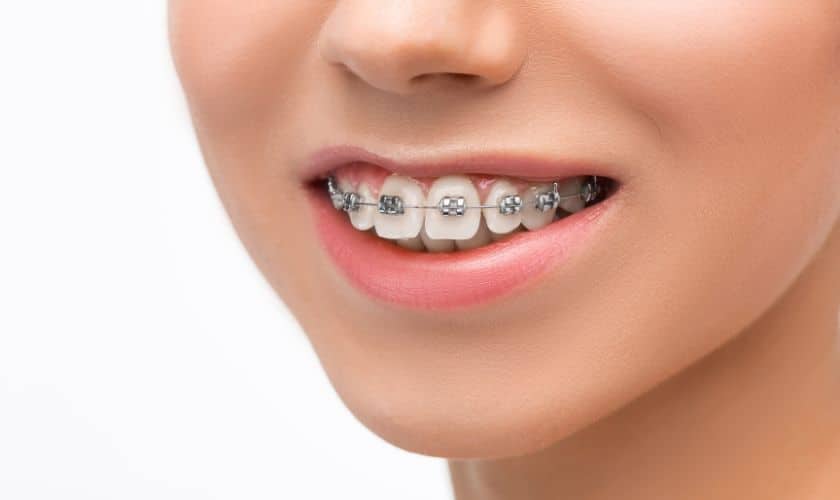 Braces in San Antonio, TX Braces in San Antonio, TX