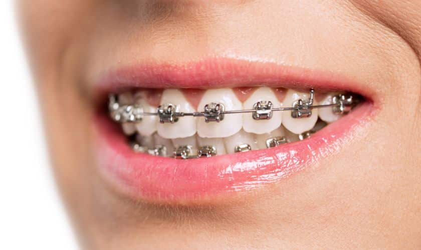 Tips to Maintain Your Braces From an Orthodontist