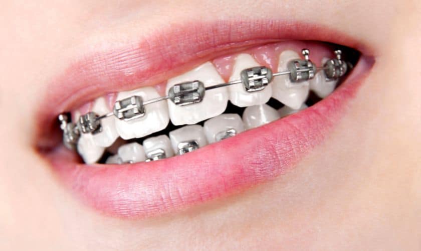 Reasons to Get Braces Even if All Teeth Are Fine