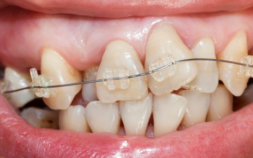 Can Braces Fix Crooked Teeth?