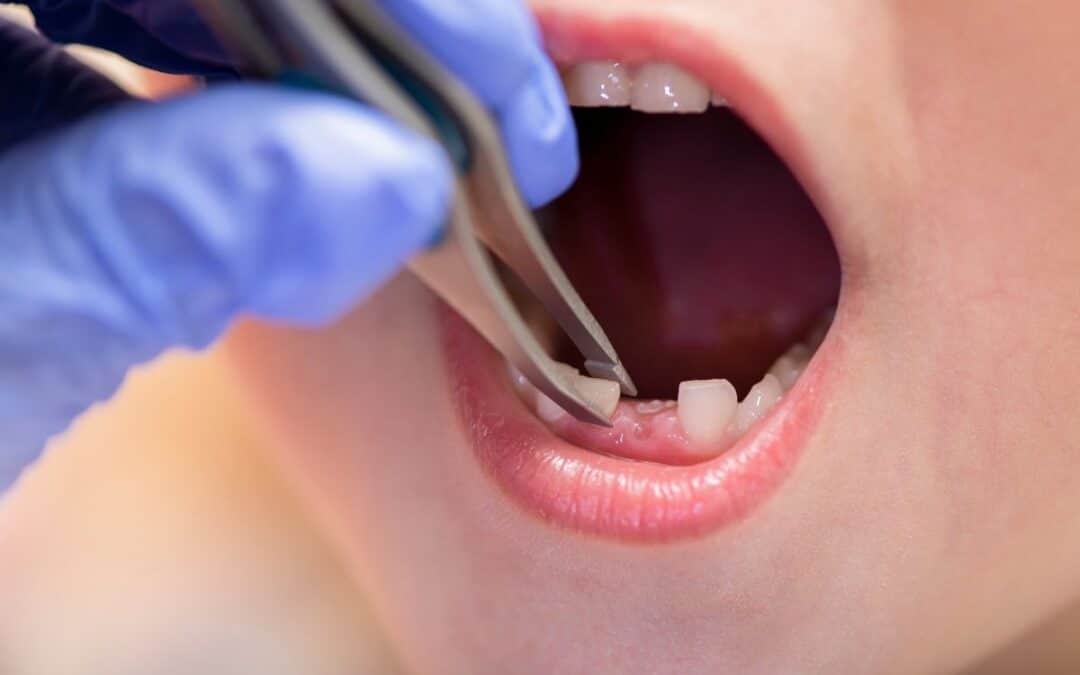 When Does Your Child Need Baby Tooth Extraction?