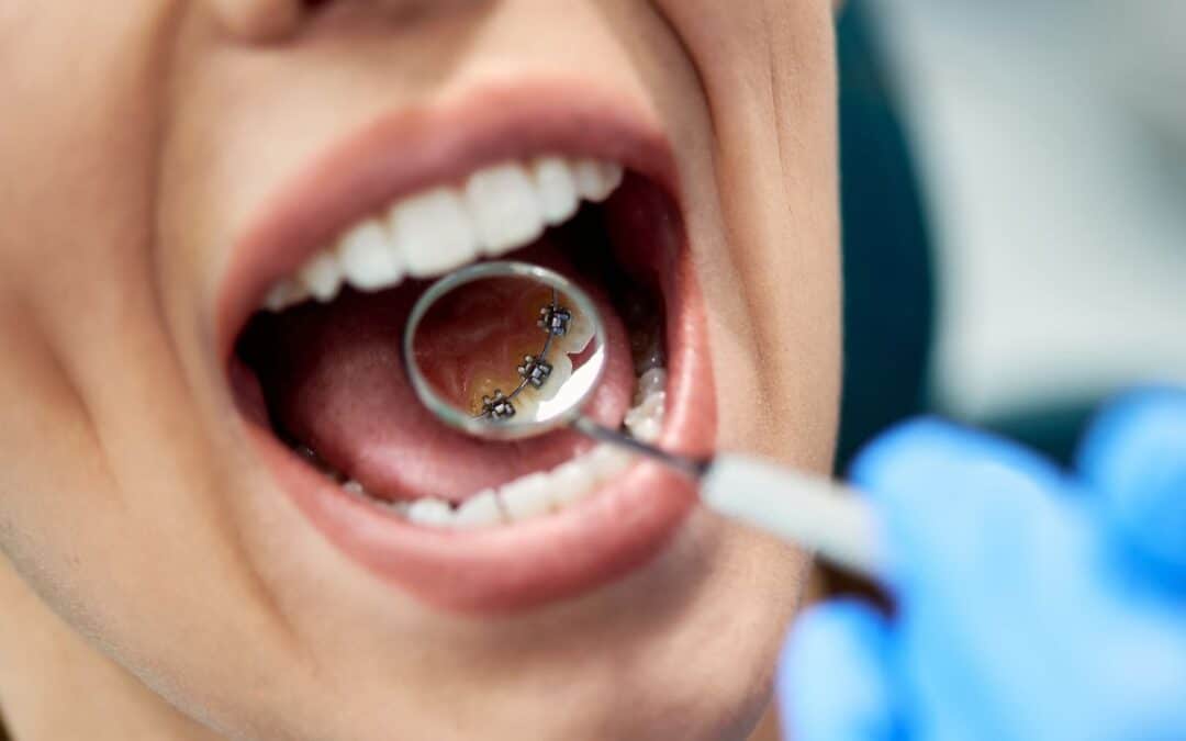 Lingual Braces: Pros, Cons, and How They Compare to Other Treatments?