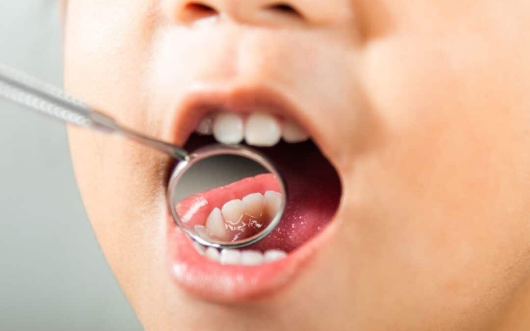 Gum Flap Over The Molar Tooth in Child