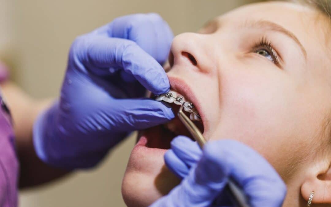 Early Warning Signs That Your Child Might Need Braces