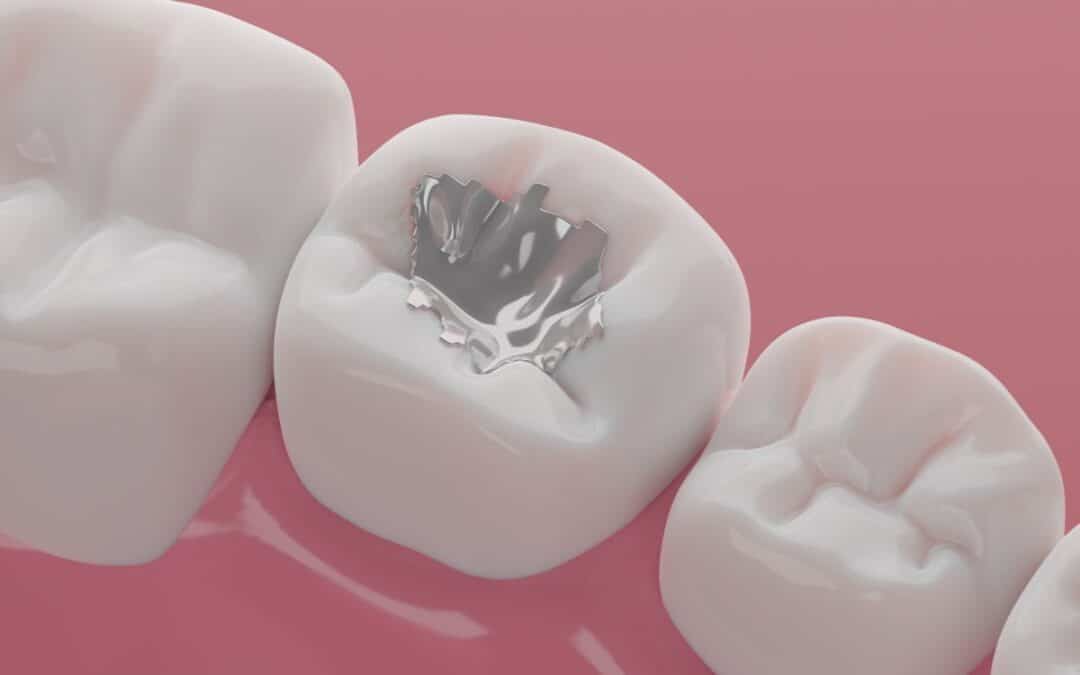 How Long Will Dental Sealants Last?