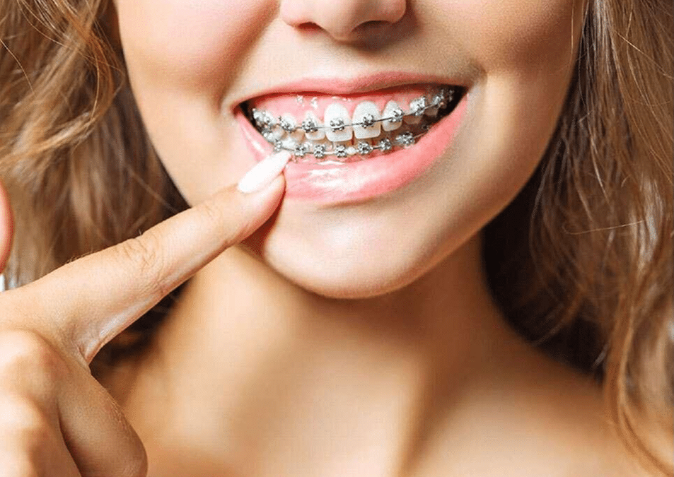 Can You Be Allergic to Metal Braces? Symptoms, Causes and Solutions