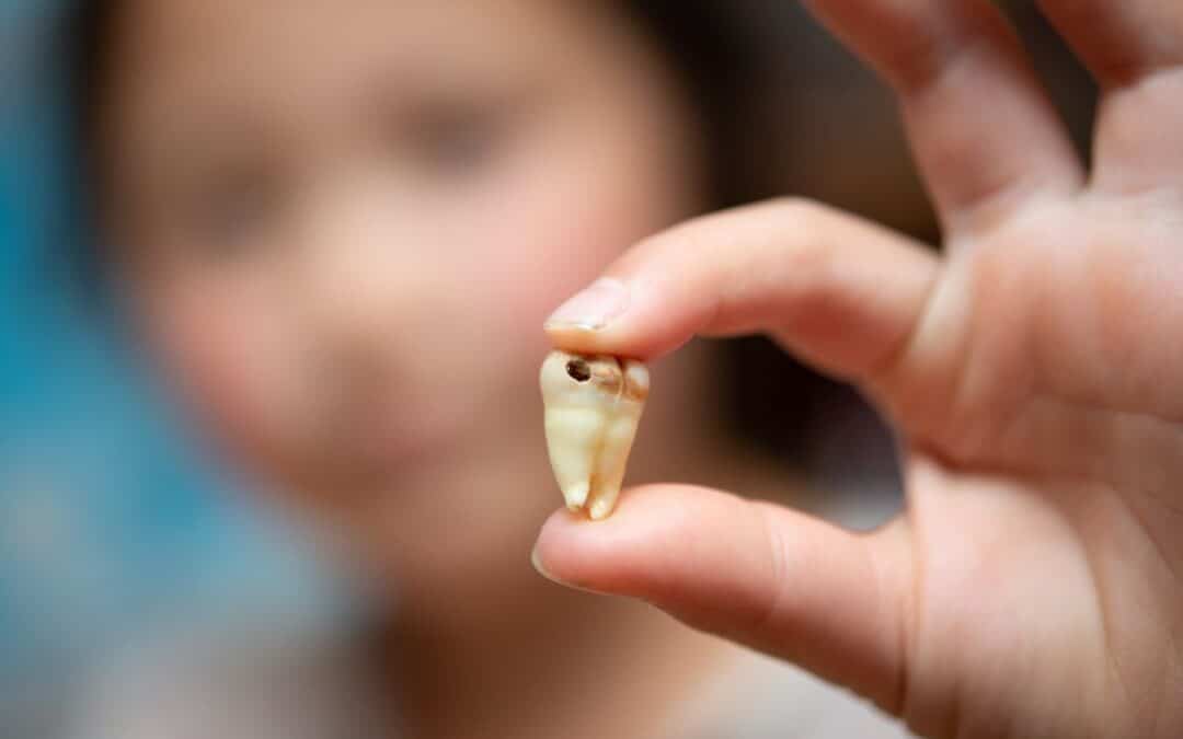 How do Pediatric Dentists help Prevent Tooth Decay in Children?