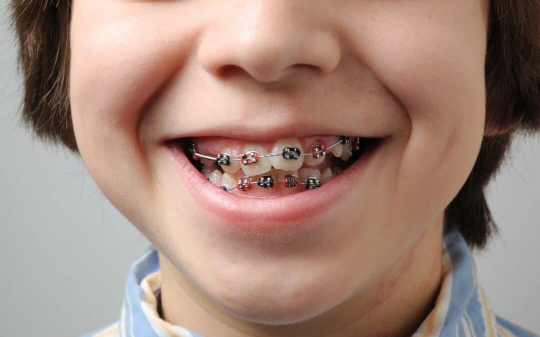 Do You Need Braces for Crowded or Misaligned Teeth?