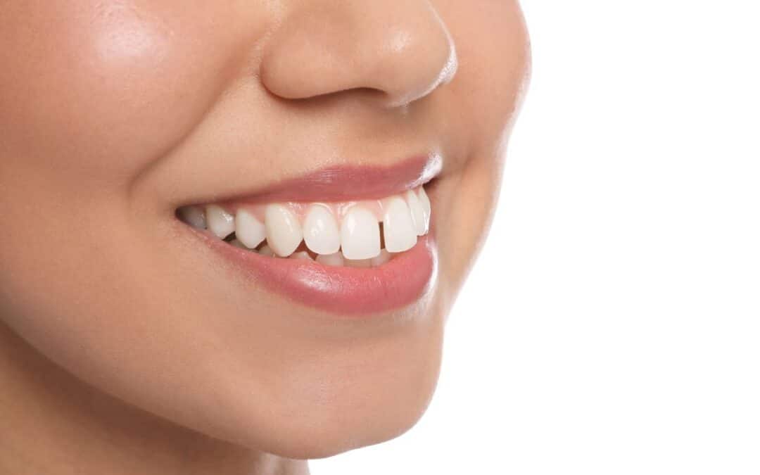 How to Fix Protruding Teeth