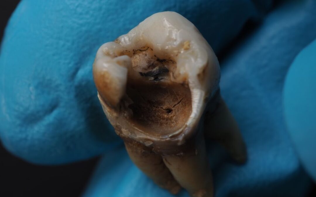 What Are The 5 Causes Of Tooth Decay In Children