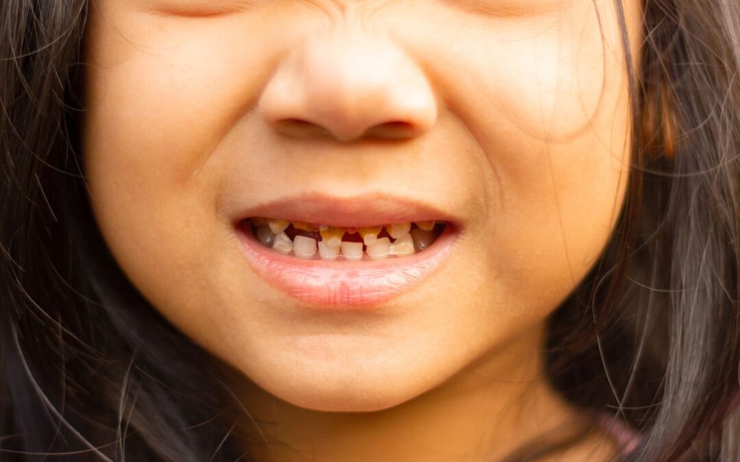 What Causes Baby Bottle Tooth Decay and How Can You Stop It?