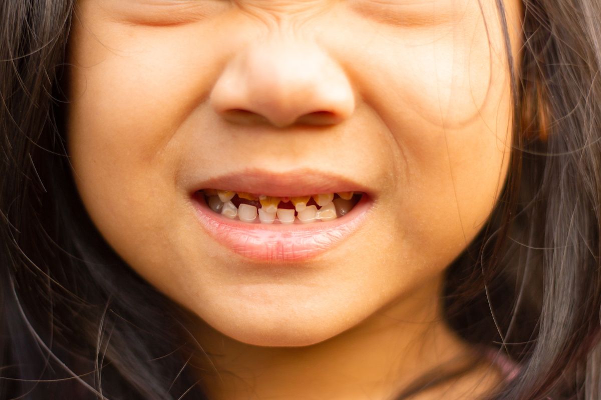 Causes of Baby Bottle Tooth Decay Causes of Baby Bottle Tooth Decay