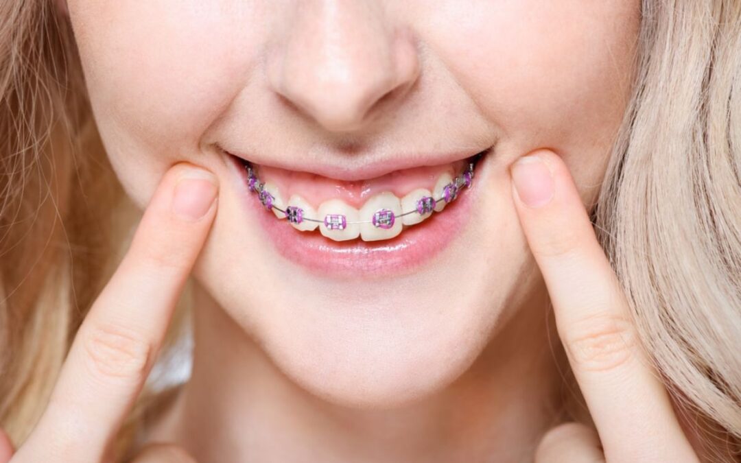 Do Braces Hurt? Ten Easy Tips on How to Reduce Braces Pain