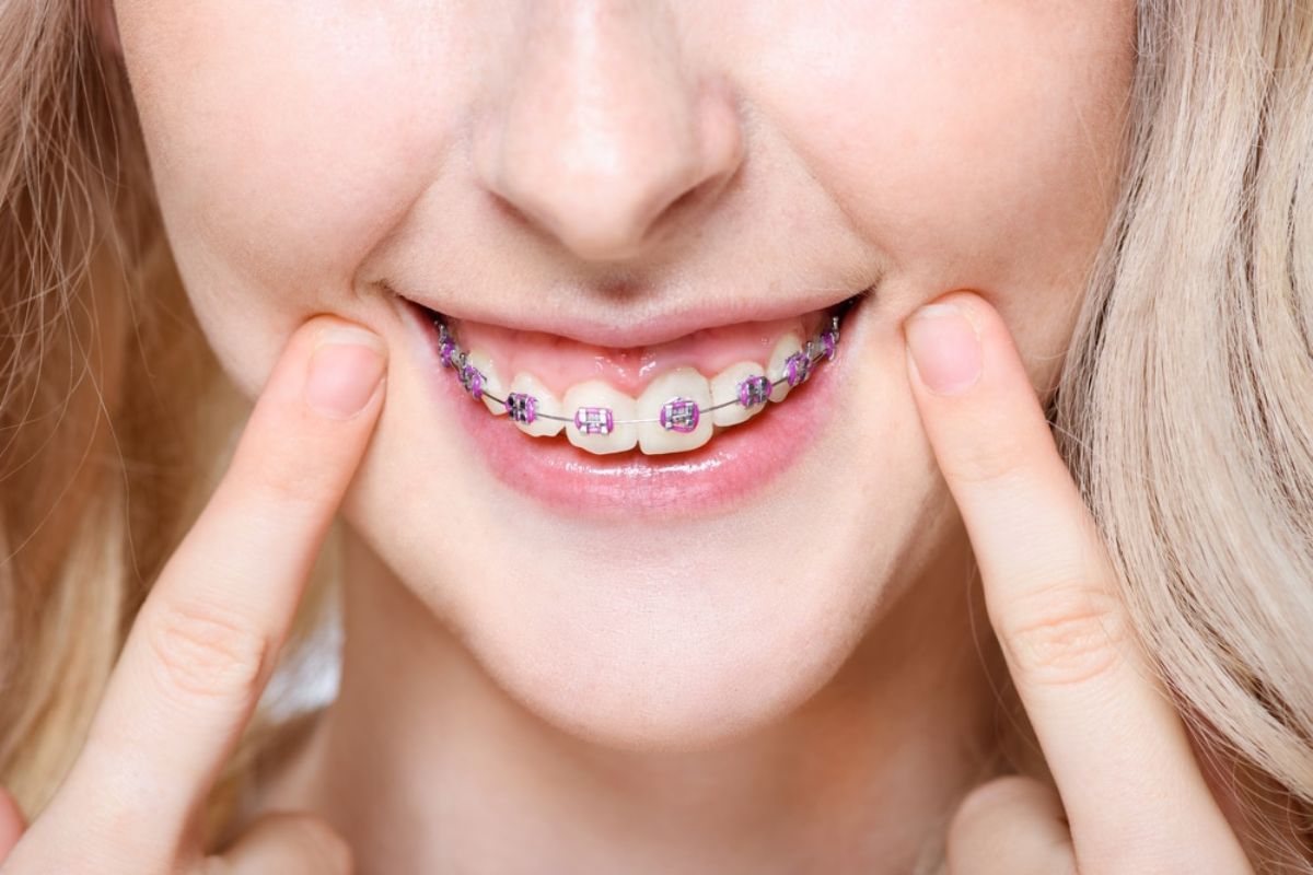 Ten Easy Ways To Stop Braces Pain