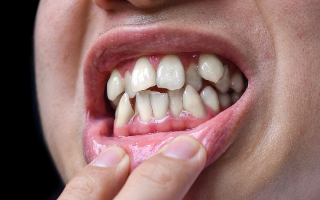 Crooked Teeth Treatment: Should You Visit an Orthodontist First?