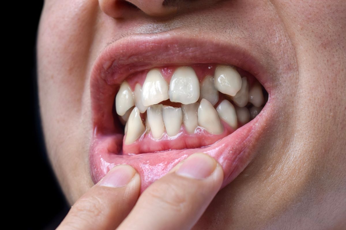 Crooked Teeth Treatment Crooked Teeth Treatment