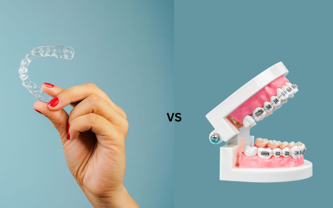 Clear Aligners vs. Traditional Braces: Which Is Right for San Antonio Teens?
