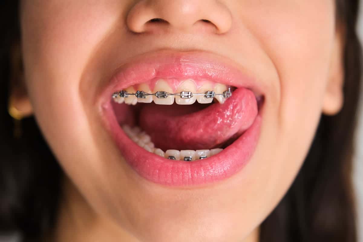 Orthodontics in San Antonio Orthodontics in San Antonio
